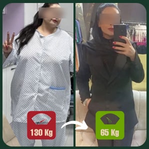 عمل لاغری اسلیو یا بای پس معده