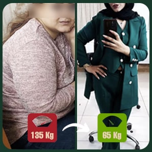 عمل لاغری اسلیو یا بای پس معده