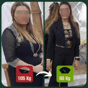 عمل لاغری اسلیو یا بای پس معده